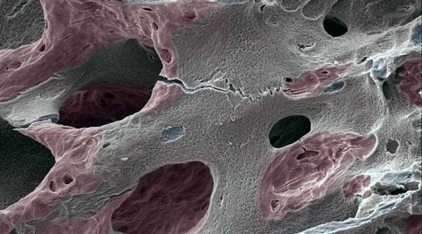 Battere l’osteoporosi con